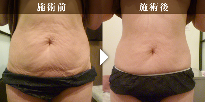 before_after